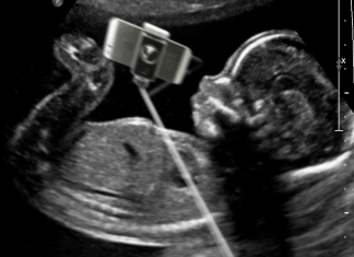 Crean un palo intrauterino para selfies de fetos
