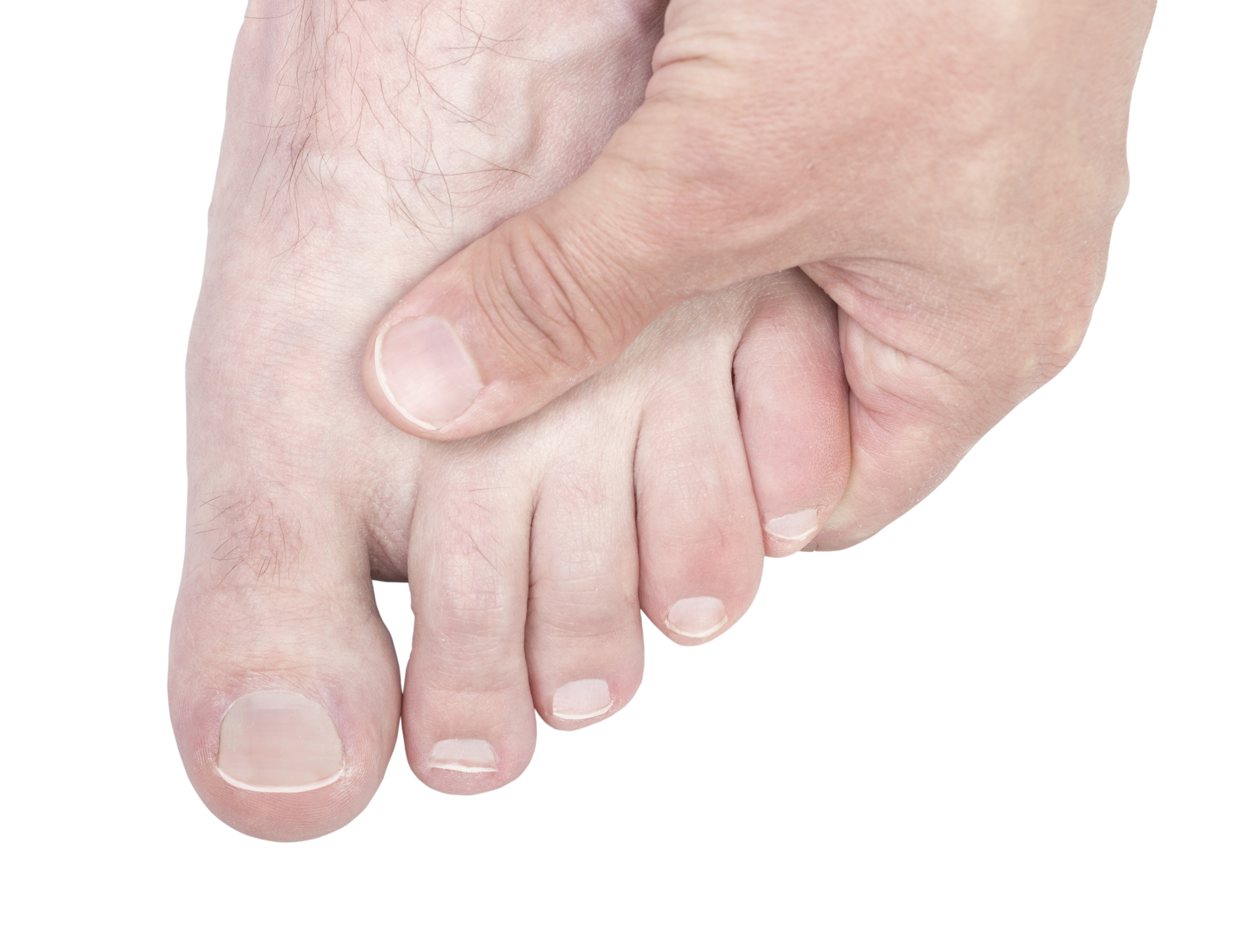 Болит большой палец на ноге чем лечить. Ушиб большого пальца стопы. Ушиб большого пальца на ноге. Травма большого пальца ноги.